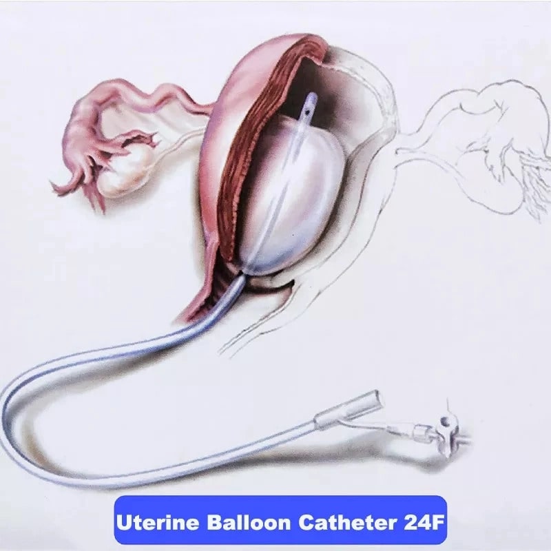 Female Catheter Medical Consumables Postpartum Hemostatic Dilation Balloon